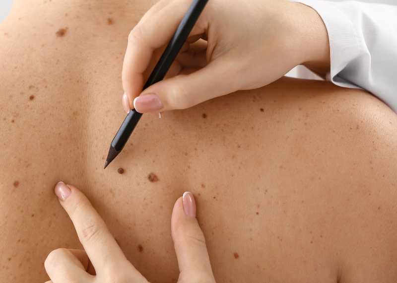 Mole Mapping - Advanced Skin Cancer Centre