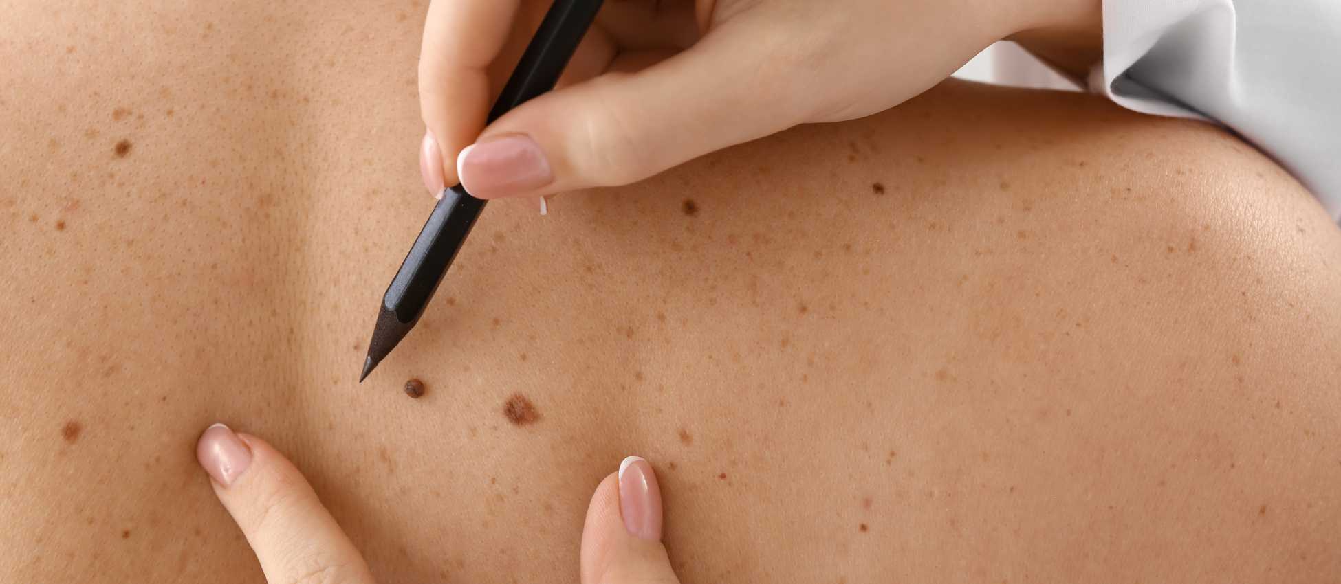 Mole Mapping - Advanced Skin Cancer Centre