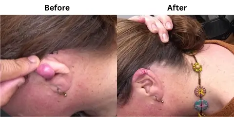 Keloid Removal 1 (1)