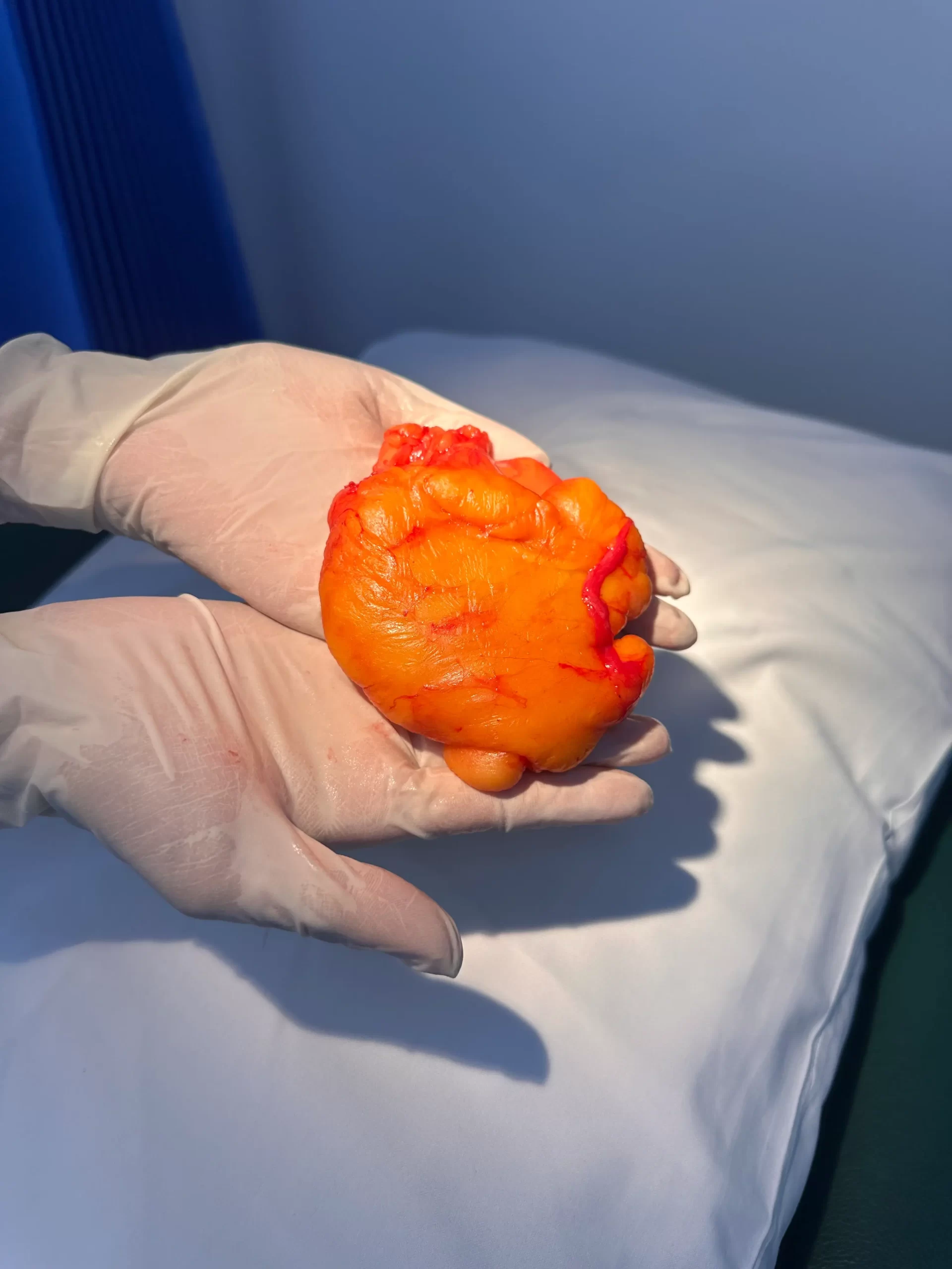 Lipoma Removal f1 (1)