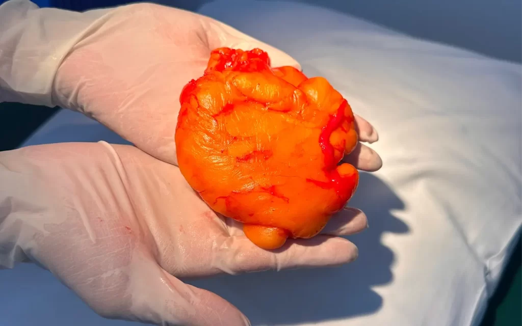 Lipoma Removal f1 (2) (1)