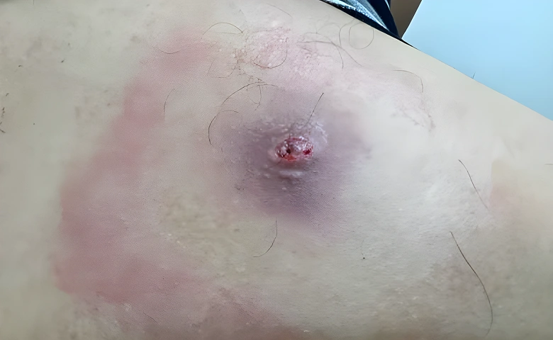 Sebaceous Cysts Removal new inner img 1.1