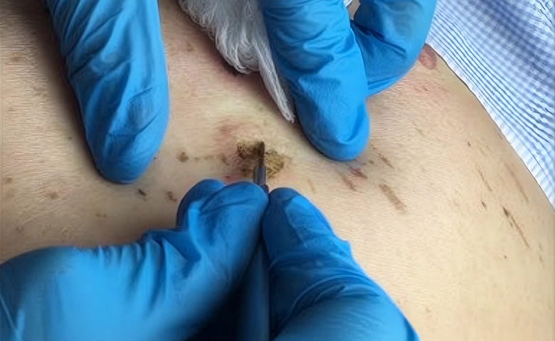 Seborrheic Keratosis Removal inner new img 1.3