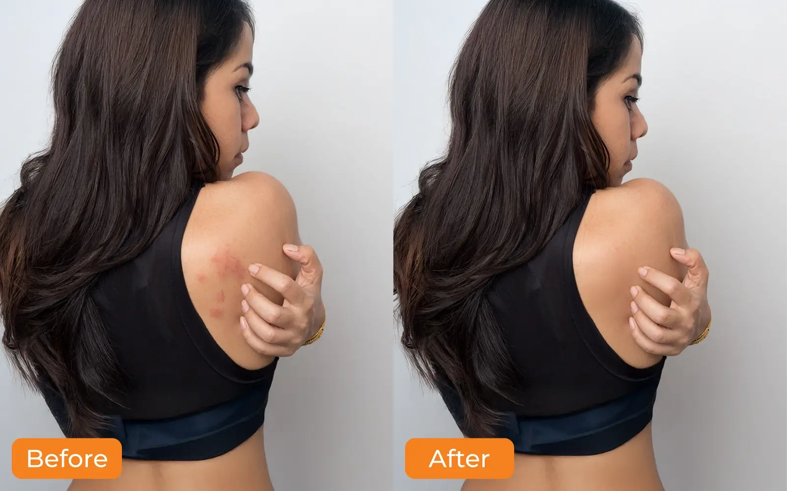 Skin Tag Removal img2 (1)