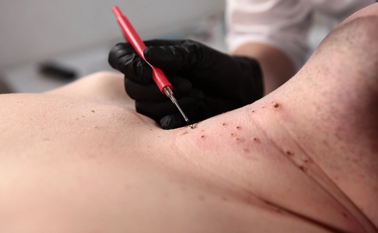 Skin Tag Removal new inner img 1.3
