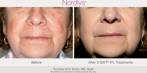 Facial Vein removal