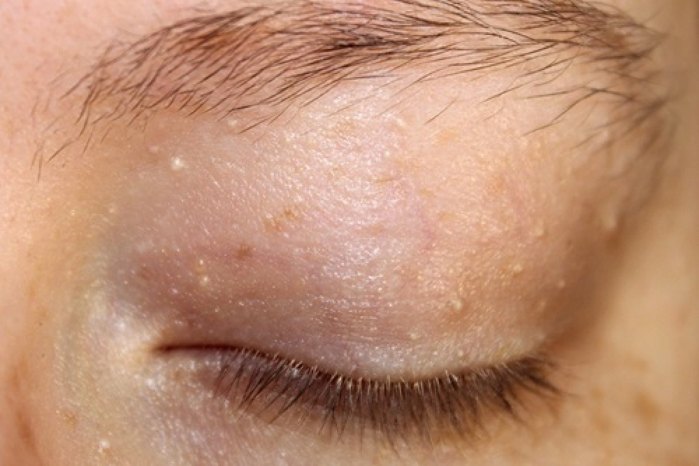 milia cyst removal